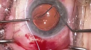 Lasso of IOL/capsular bag with Gore Tex suture - Eyetube