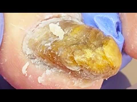 Severe Onychomycosis And Dead Skin Afflict Patients【Podiatry Clinic】