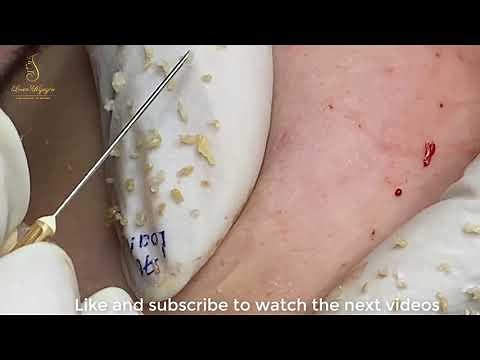 Remove hidden acne under the skin (70) | Loan Nguyen