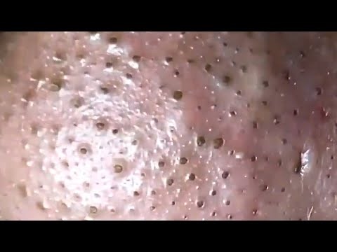 Blackheads & Whiteheads Satisfying Removal @0004