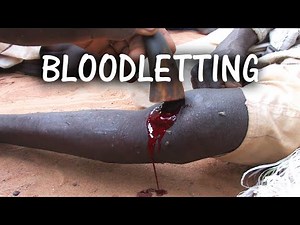 Modern Day Blood-letting in Africa