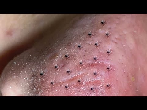 Suri Job #548: Amazing Blackheads and Inflamed Acne Extraction