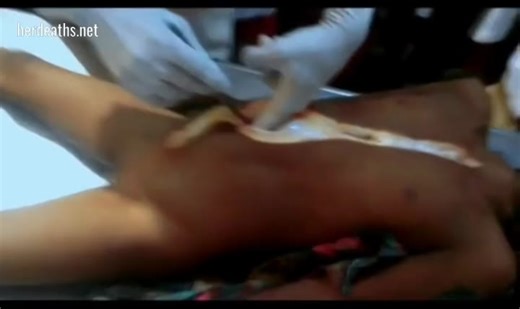 AUTOPSY OF A YOUNG WOMEN VICTIM OF A MURDER IN INDIA