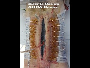 How to Use an ABRA Device to Keep an Abdominal Wall Closed