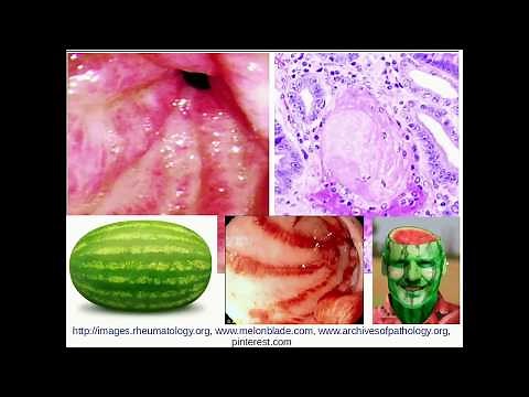 Histopathology - Gastric Antral Vascular ectasia (GAVE)