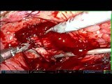 Transvesical Prostatectomy on Patient with 283g Prostate • Video • MEDtube.net