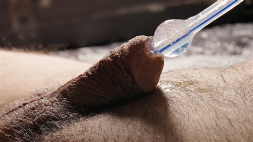 Urethra dilation with inflatable catheter