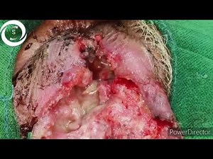 Maggots in Eye