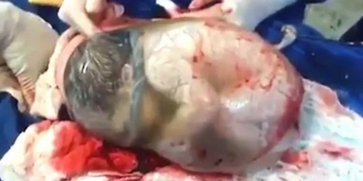 Watch a baby being born within the amniotic sac, which only happens 1 in every 80,000 births