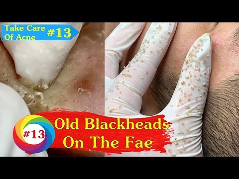 Old Blackheads In The Man's Face | Care Of Acne Treatment (#13)