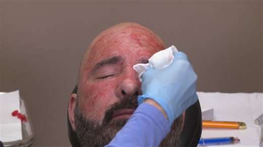 Vampire facials: The trending Halloween beauty treatment