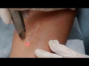 PRODERM Laser Treatment - Scar