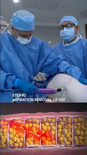 Gender Affirming Surgery - 360 Lipo & BBL with Rib Remodeling! Before & After Results!