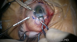 Fixation of Iris-IOL Complex in an Aphakic Patient With Iris Defect - Eyetube