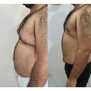 🔴In this video Dr Arif is explaining his students and staff about how fats work and about tumescent and safe lipo . 🔴Tumescent liposuction results in less bleeding during the procedure and less bruising, swelling, and other painful issues afterwards. 🔶Follow us on Instagram and Facebook for all updates 🔶Facebook: https://www.facebook.com/Aestheticshapes 🔶Instagram: https://www.instagram.com/aestheticshapespk 🔶 Fill out the simple form to book your 𝗶𝗻𝗶𝘁𝗶𝗮𝗹 𝗢𝗻𝗹𝗶𝗻𝗲 𝗖𝗼𝗻𝘀𝘂𝗹𝘁