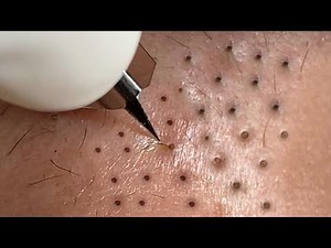 Huong Da Nang Acne Treatment #375