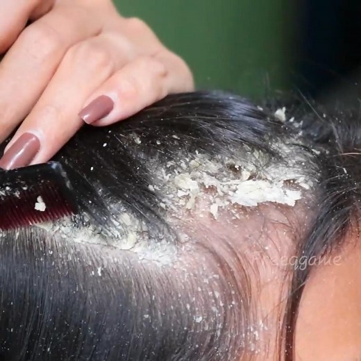 148K views · 451 reactions | Beautiful Girl Satisfying Biggest Dandruff #dandruffremoval #dandruffshampoo #dandruffproblems #dandrufftreatment | FreeQgame | Facebook