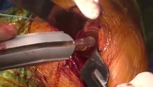 Anatomic Total Shoulder Arthroplasty Surgical Procedure