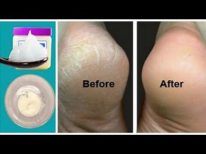 How to get rid of cracked heels naturally fast with this magical remedy
