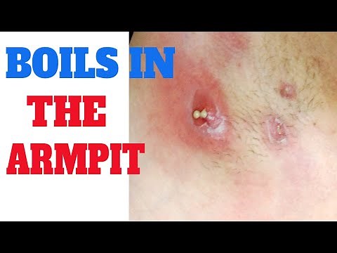 Boil in armpit | Symptoms of boil in armpit | Arm pit pus | Underarm bump
