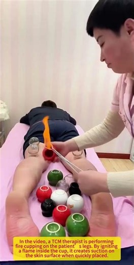 🔥Fire Cupping Therapy — Traditional Healing Power!