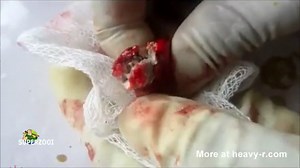 Removing a scalp cyst