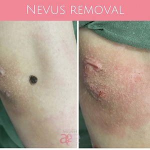 Before and After #Nevus_Removal in #Nouvelage Clinics with Dr. Hadeer gaber _____________________ Send us your requirements in a message or comment 📩 or call us : 16823 📞 | Nouvel Âge Clinics