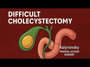 Laparoscopic Cholecystectomy in a Difficult Case. 4- port. Gallbladder removal