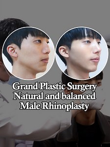 Natural and balanced Rhinoplasty with Grand Plastic Surgery | Grand Plastic Surgery, Korea | Facebook