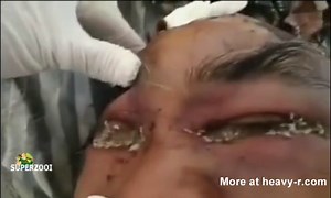 Eyes Eaten By Maggots