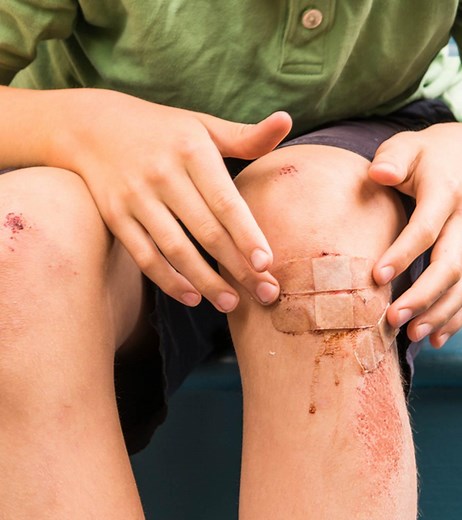 Bruising In Children: 11 Warning Signs & Prevention Tips