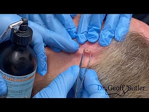 Removal of a Squamous Cell Cancer from behind the Ear