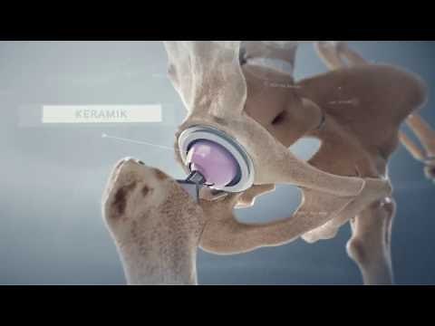 «Hüftprothese» - Schulthess Klinik