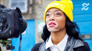 Chantelle Brown-Young, mannequin et malade du vitiligo - Madmoizelle