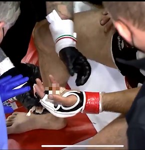 brutal! Worst MMA injury ever: Fighter loses his finger clean off his hand at CCFC 94 and somehow finishes the round