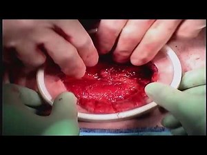 The Anatomic Radical Prostatectomy