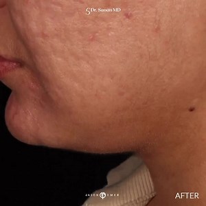 DEEP PLANE FACE AND NECK LIFT