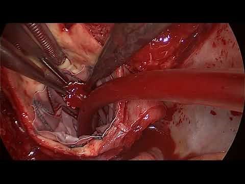 Type A Dissection Repair With Fenestrated Frozen Elephant Trunk