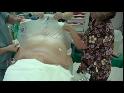 traxi® Panniculus Retractor (10 second clip of retraction)