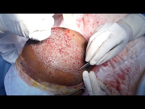 How Does Hair Transplant Work? Step by step Complete Surgery