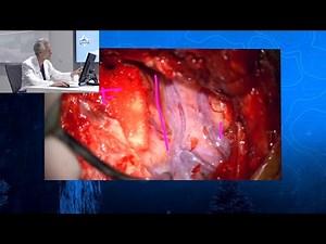 Episode 4: Clipping of Anterior Communicating and Right Middle Cerebral Artery Aneurysms