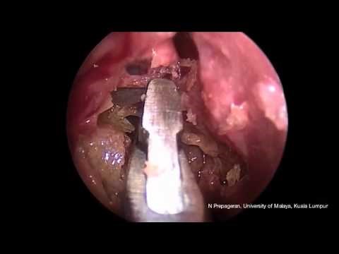 Basic FESS: Step by step