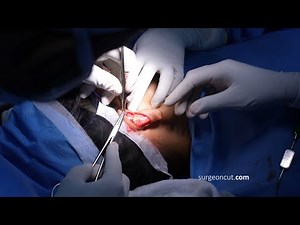 Ear Pinning Otoplasty for a Man - Complete Surgery