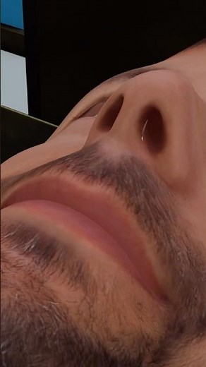 3d animation of Nasal Septoplasty #shotrs