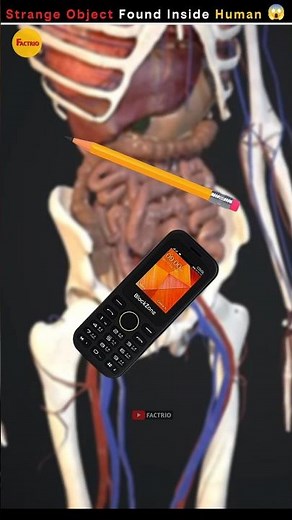 Strange Object Found Inside Human Body 😱