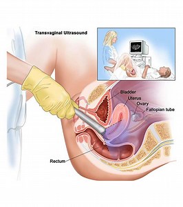 Transvaginal Ultrasound During Pregnancy: A Complete Guide