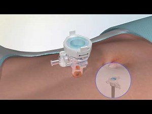 Laparoscopic Trocar - The Newest Technology