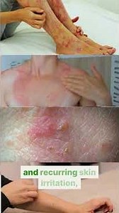 ANCIENT WISDOM FOR DERMATITIS HERPETIFORMIS | TheTole Acupuncture #datotole #thetoleacupuncture