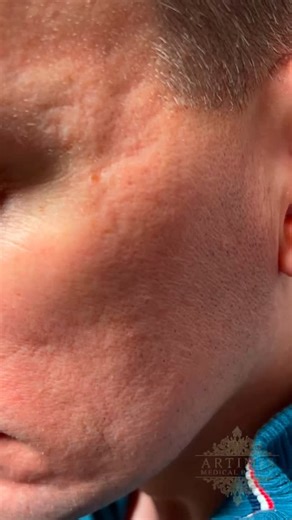 Før vi begynner behandlingen av akne og akne arr, er det viktig å vurdere alle relaterte hudproblemer. Dette gir oss et helhetlig bilde av tilstanden før vi kartlegger og planlegger behandlingen. Behandling av akne arr kan være mer utfordrende for menn enn for kvinner, hovedsakelig på grunn av tykkere hud, hormonelle forskjeller og lavere tilbøyelighet til å oppsøke behandling. Livsstilsfaktorer som røyking kan også påvirke hudens helse. Det er derfor viktig med konsultasjon på forhånd for både 