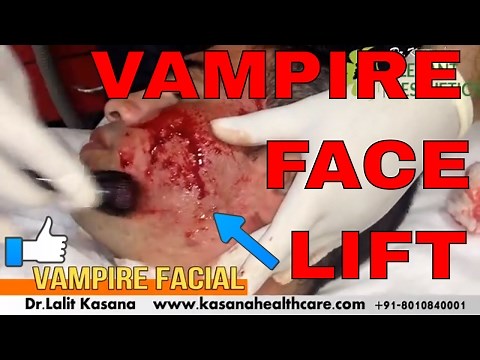 VAMPIRE FACIAL or BLOOD FACIAL PRP
